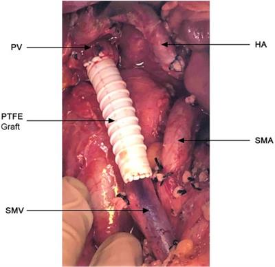 Portal-mesenteric vein resection for pancreatic cancer: Results in par with the defined benchmark outcomes